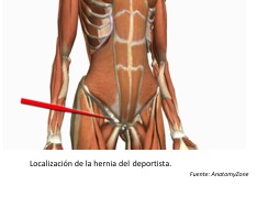 Localización de la hernia del deportista. Fuente: AnatomyZone 